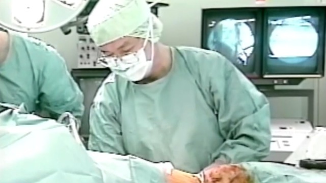 熊野潔先生　手術動画 1995年　日本外科系連合　フィルム・ビデオライブラリ
"Lordosisization Method for Kyphotic Deformity by Using Spinal Instrumentation of Hooks-Rods System with Pedicle Screws"
